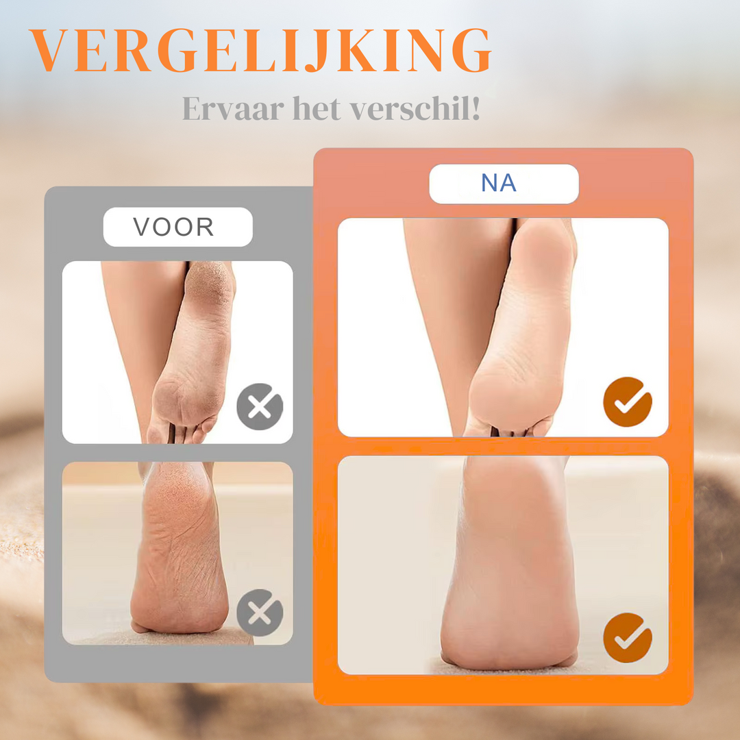 SmoothFeet™ Draadloze eeltverwijderaar